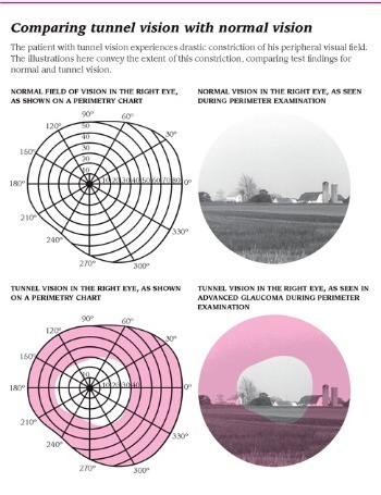 Field Of Vision Chart