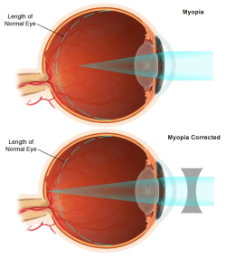 Hyperopia Is A Refractive Error